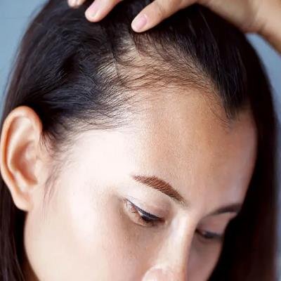 Is a Female Hair Transplant Suitable for Thinning Hair?